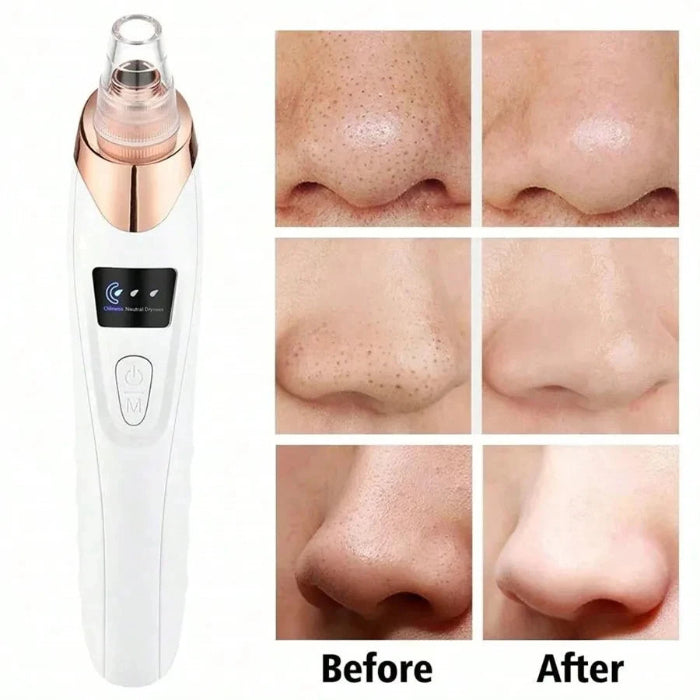 Electric Vacuum Pore Cleaner & Blackhead Remover – Deep Cleansing Device for Face Skin Care